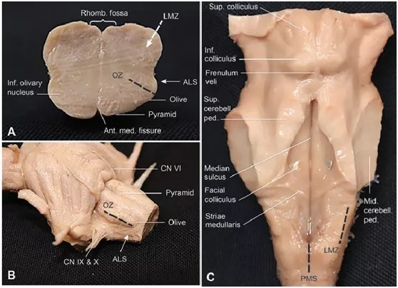 腦干延髓腫瘤順利全切可能嗎？?jī)蓜t成功案例交流